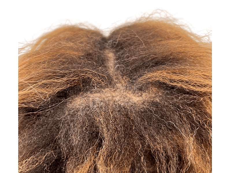 Thinning dark brown hair on scalp. Potential hair loss. Consider hair restoration or transplant options. Before/After results may vary.