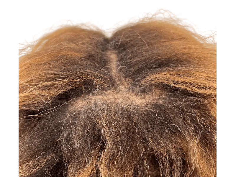 Thinning dark brown hair on scalp. Potential hair loss. Consider hair restoration or transplant options. Before/After results may vary.