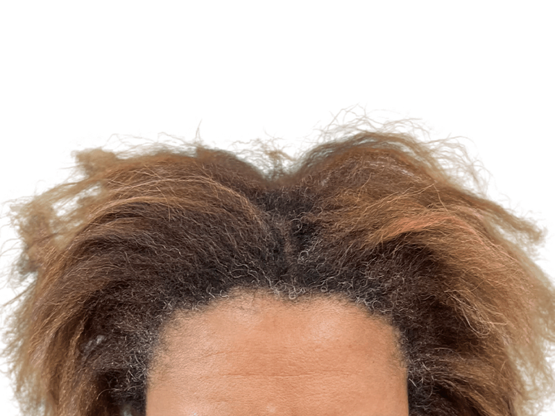 Thinning hairline. Potential hair loss candidate. Consider hair transplant options for fuller hair. Before/After results may vary.