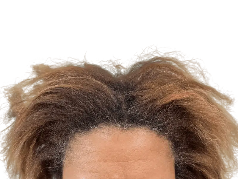 Thinning hairline. Potential hair loss candidate. Consider hair transplant options for fuller hair. Before/After results may vary.