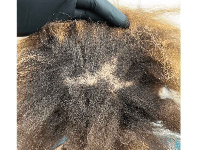 Thinning crown hair. Possible hair transplant candidate. Before hair restoration procedure. Dark brown, curly hair.