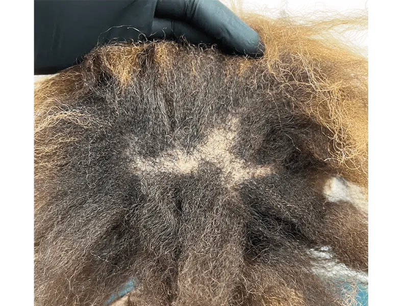 Thinning crown hair. Possible hair transplant candidate. Before hair restoration procedure. Dark brown, curly hair.