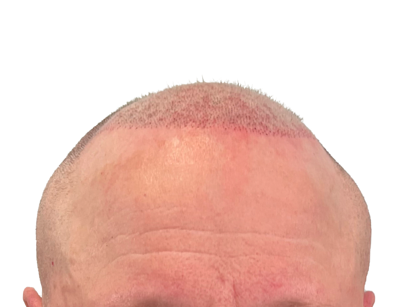 Hair transplant close-up: Recent procedure showing hairline redness. Possible before/after hair restoration result. Caucasian male.