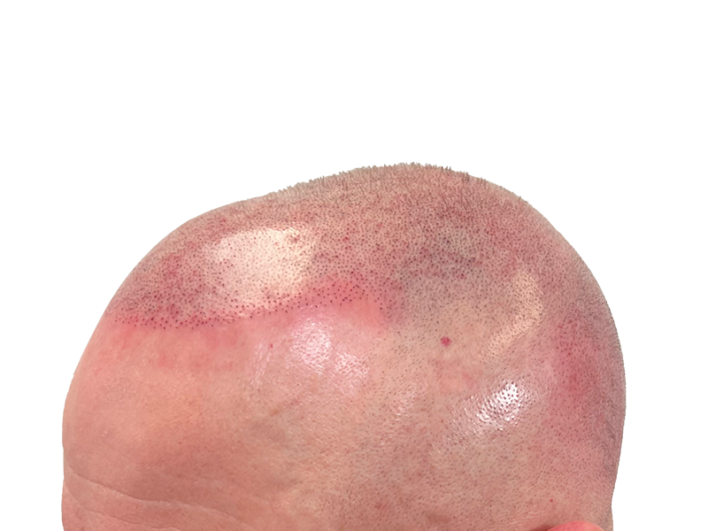 Hair transplant result: Close-up of scalp showing newly transplanted follicles. Hair restoration procedure success.