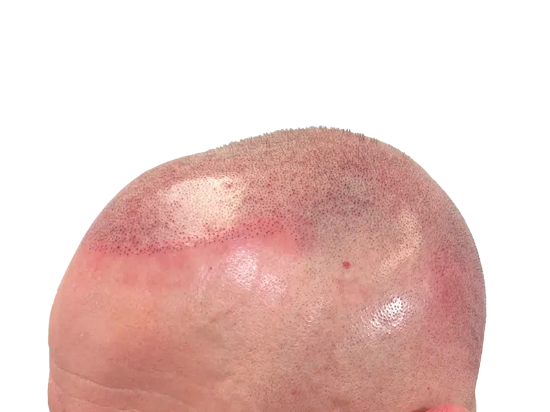 Hair transplant result: Close-up of scalp showing newly transplanted follicles. Hair restoration procedure success.