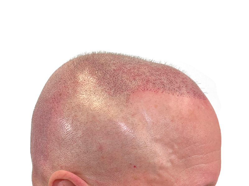 Hair transplant result: Close-up of transplanted follicles on a balding head. Hair restoration procedure shown.
