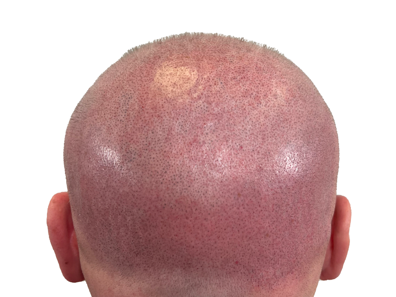 Hair transplant result: Back of head showing uniform hair growth after restoration. Before/after hair loss solution.
