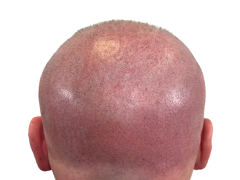 Hair transplant result: Back of head showing uniform hair growth after restoration. Before/after hair loss solution.