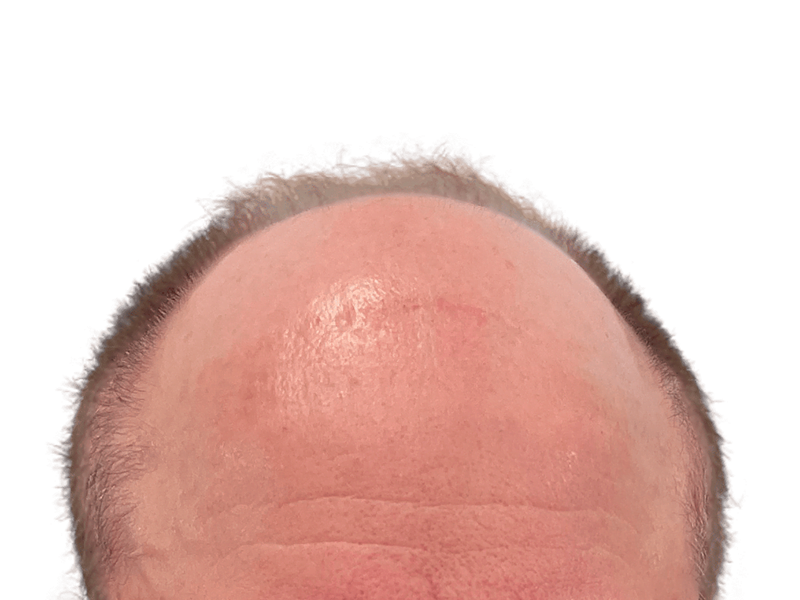 Receding hairline close-up. Hair restoration candidate? Sparse hairs suggest possible hair transplant. Before/after comparison needed.