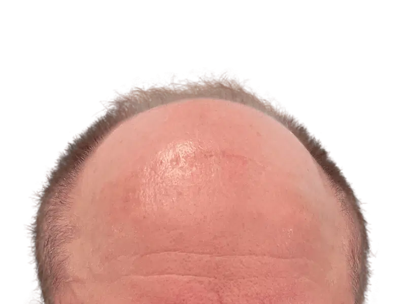 Receding hairline close-up. Hair restoration candidate? Sparse hairs suggest possible hair transplant. Before/after comparison needed.