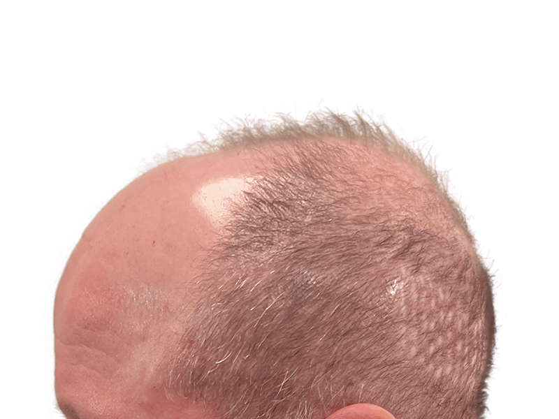 Thinning gray hair, balding crown. Potential hair transplant before photo. Hair restoration candidate.