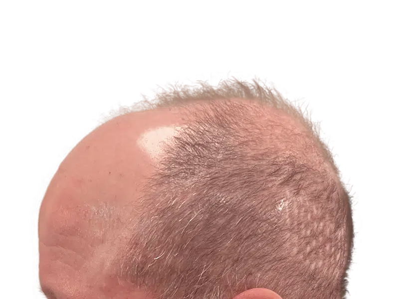Thinning gray hair, balding crown. Potential hair transplant before photo. Hair restoration candidate.