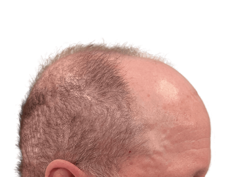 Before hair transplant: Balding Caucasian man with thinning, graying hair. Hair restoration results possible.