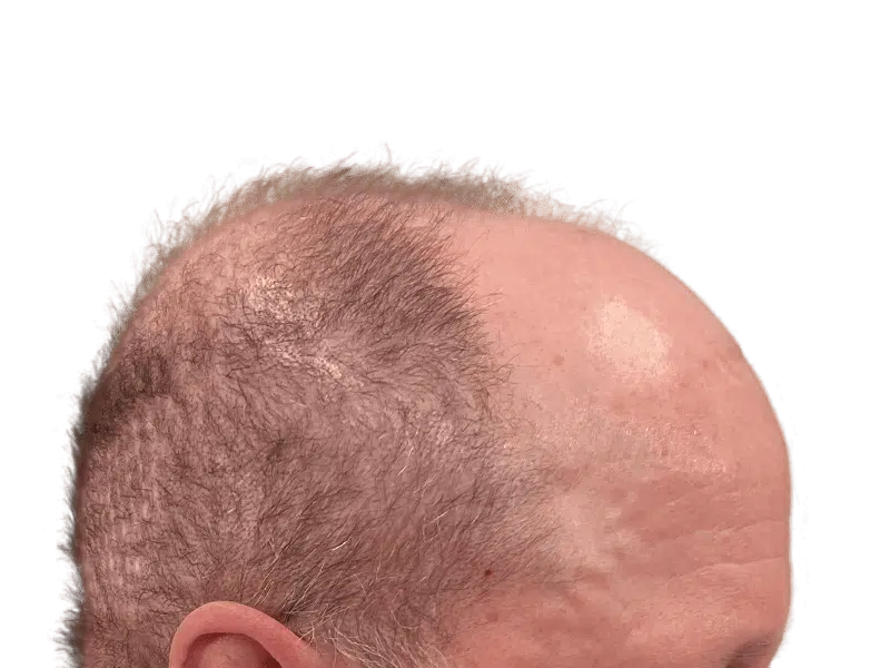 Before hair transplant: Balding Caucasian man with thinning, graying hair. Hair restoration results possible.