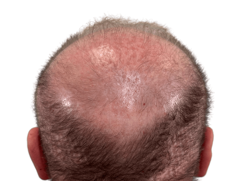 Advanced hair loss: thinning crown & visible scalp. Consider hair restoration options for fuller, thicker hair. Before treatment.