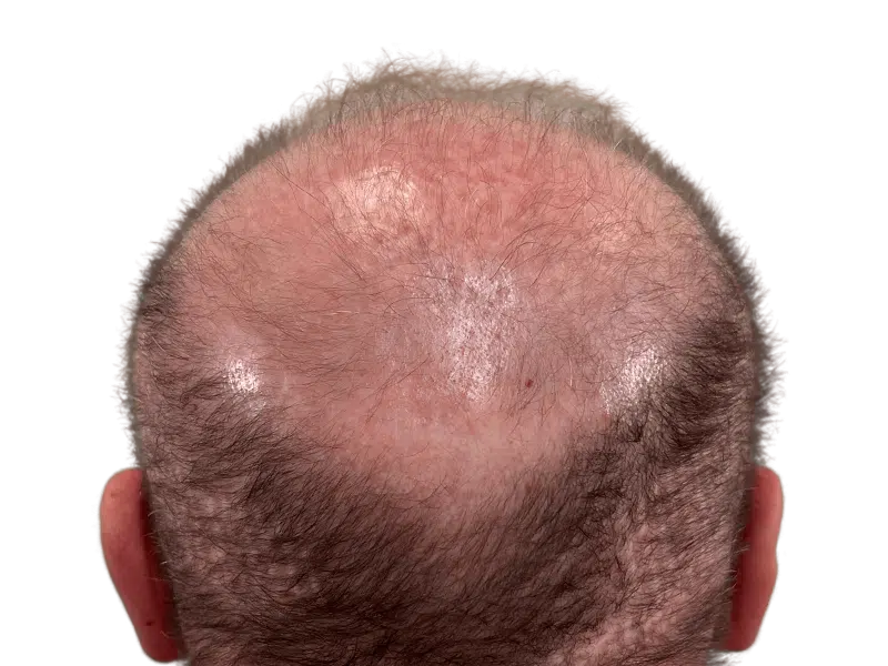 Advanced hair loss: thinning crown & visible scalp. Consider hair restoration options for fuller, thicker hair. Before treatment.