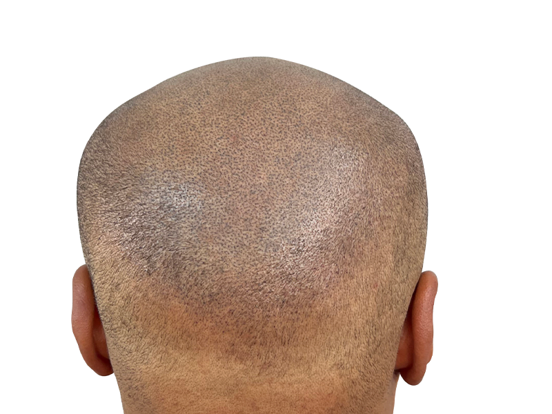 Hair transplant result: Close-up of evenly distributed hair follicles post-procedure. Hair restoration success.
