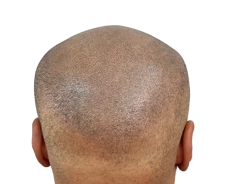 Hair transplant result: Close-up of evenly distributed hair follicles post-procedure. Hair restoration success.
