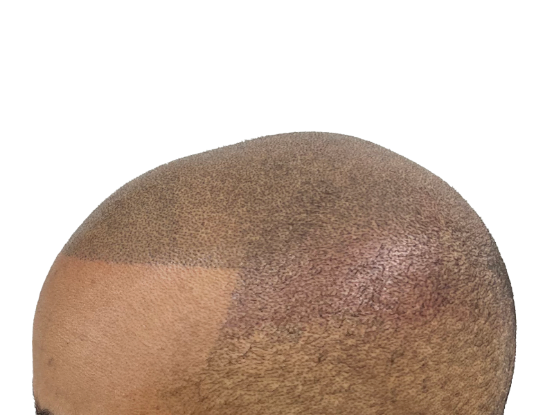 Hair transplant result: Thicker hair on top after restoration. Before/after showing improved density. Hair restoration success.