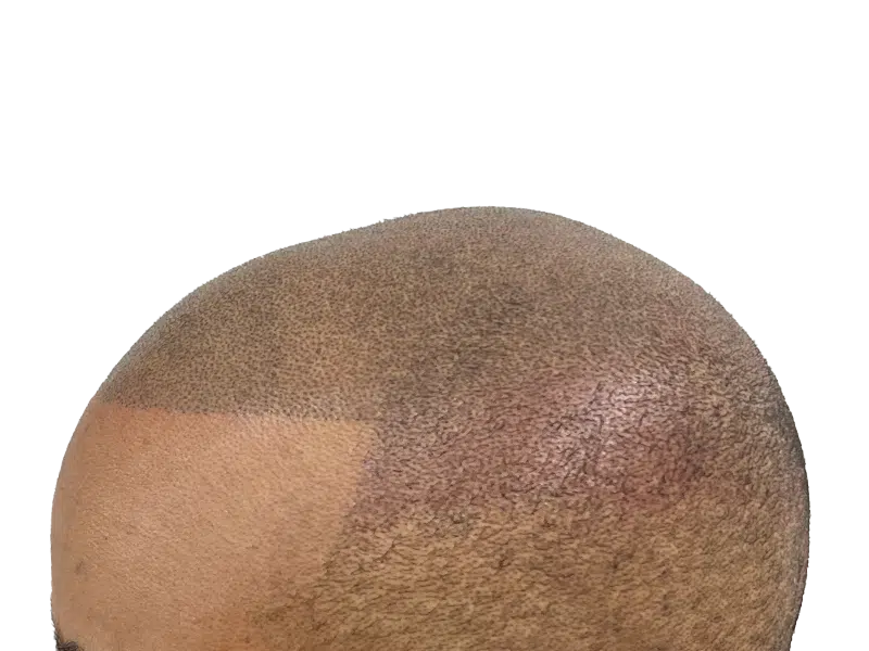 Hair transplant result: Thicker hair on top after restoration. Before/after showing improved density. Hair restoration success.