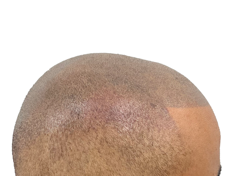 Hair transplant result: Dark hair, medium skin tone. Post-procedure scalp showing denser hair growth. Hair restoration success.