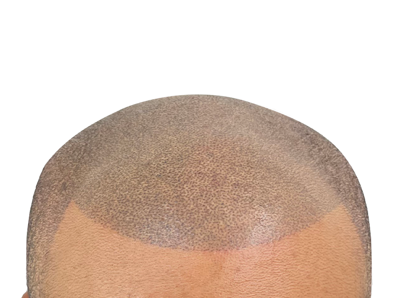 Hair transplant result: Fuller hairline achieved. Before/after shows restored hair density on scalp. Hair restoration success.