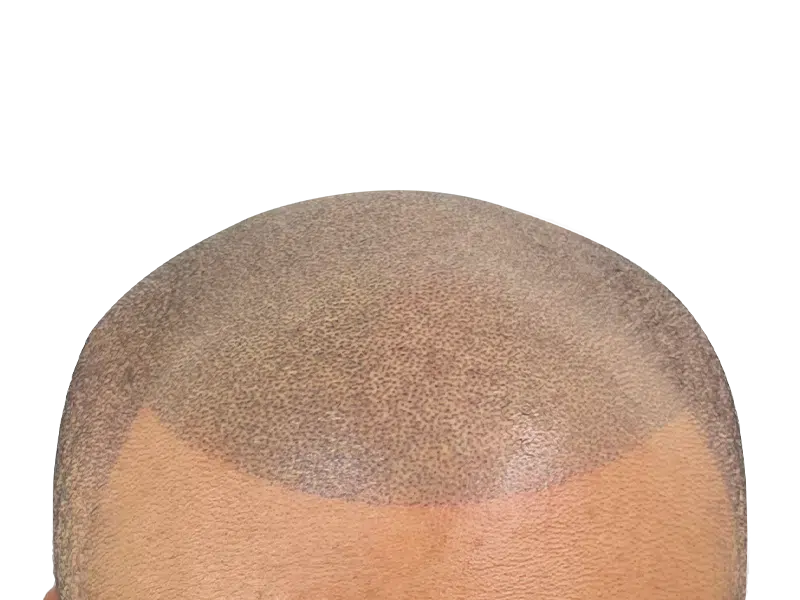 Hair transplant result: Fuller hairline achieved. Before/after shows restored hair density on scalp. Hair restoration success.