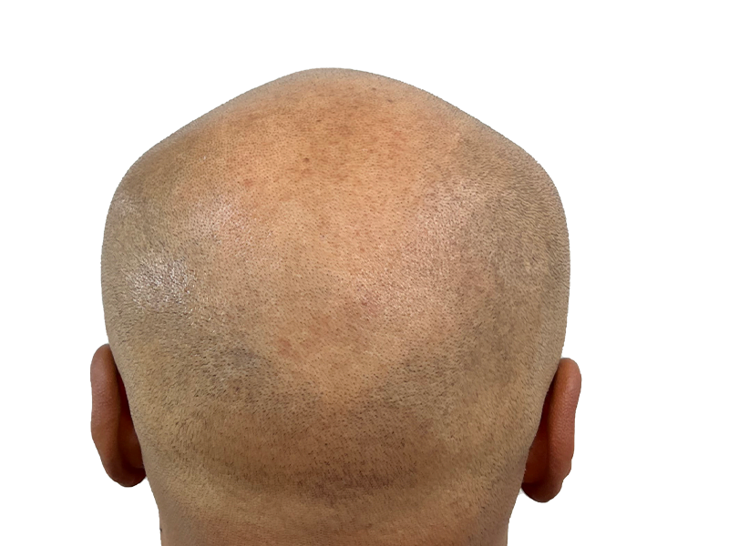 Hair transplant result: Back of head showing even, short hair growth. Successful hair restoration procedure. Before/after transformation.