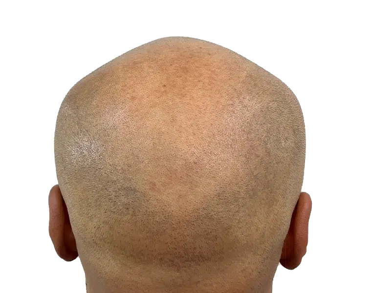 Hair transplant result: Back of head showing even, short hair growth. Successful hair restoration procedure. Before/after transformation.