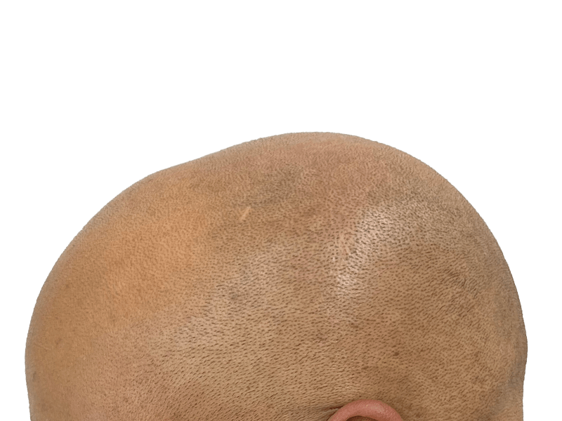 Balding head (before hair restoration). Light brown skin, short dark hair. Consider hair transplant options.