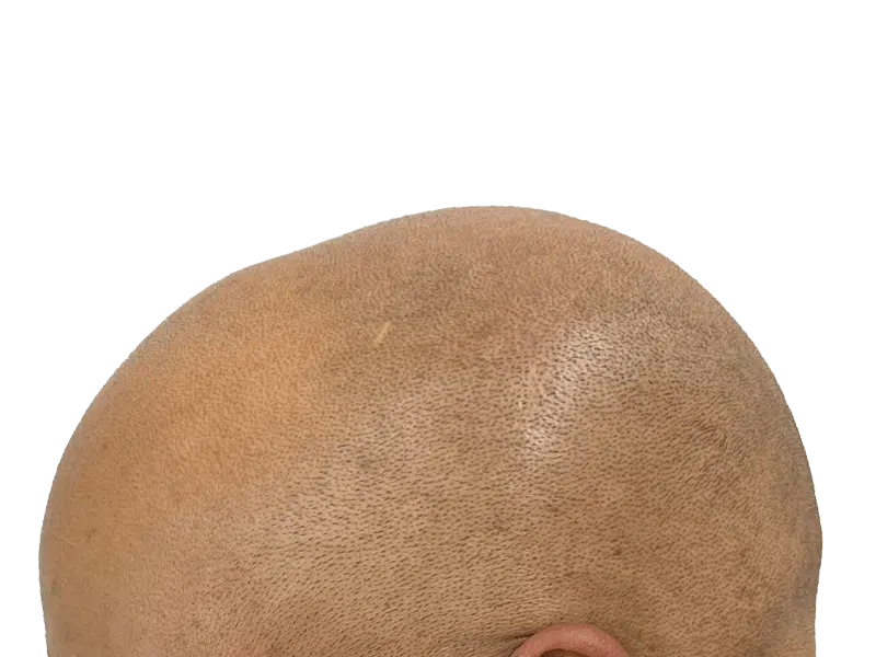 Balding head (before hair restoration). Light brown skin, short dark hair. Consider hair transplant options.