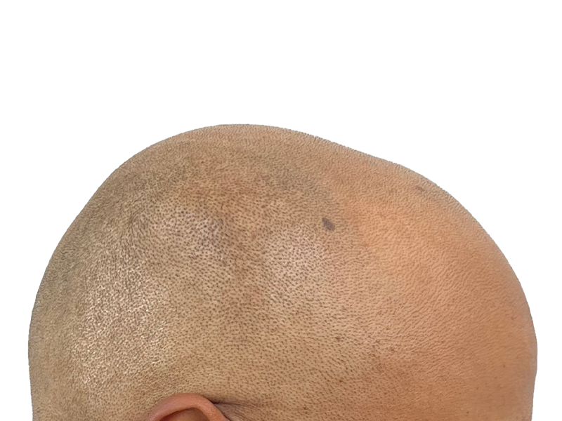 Shaved scalp close-up. Considering hair restoration? See potential hair transplant results. Light brown skin, visible follicles.