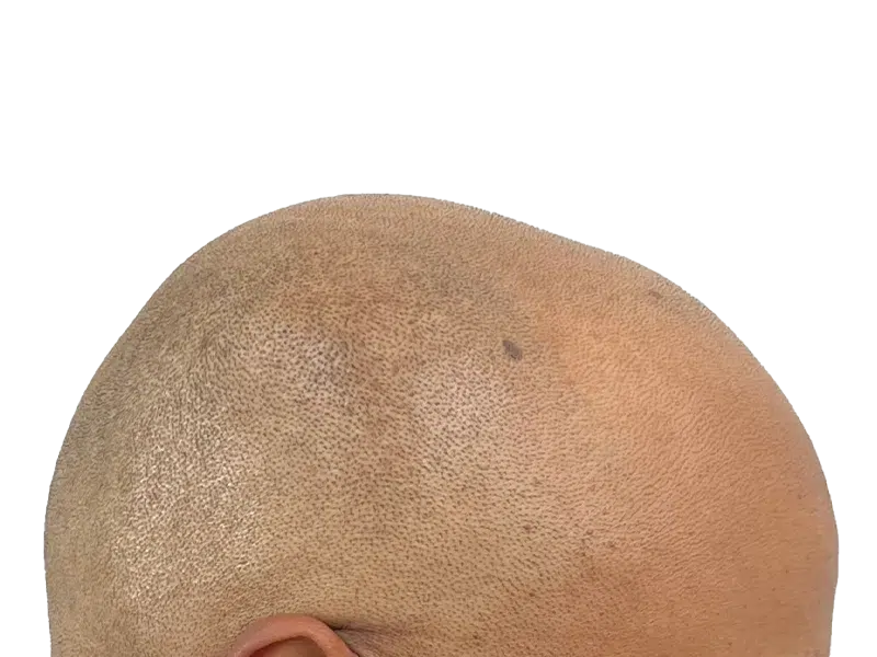 Shaved scalp close-up. Considering hair restoration? See potential hair transplant results. Light brown skin, visible follicles.