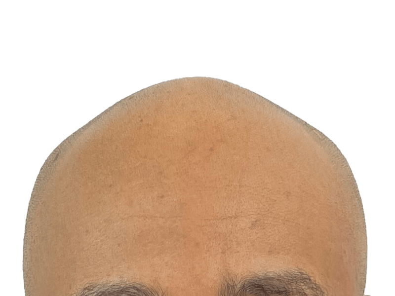 Hair transplant result: Dense, restored hairline on Caucasian man. Before/after potential. Hair restoration success.