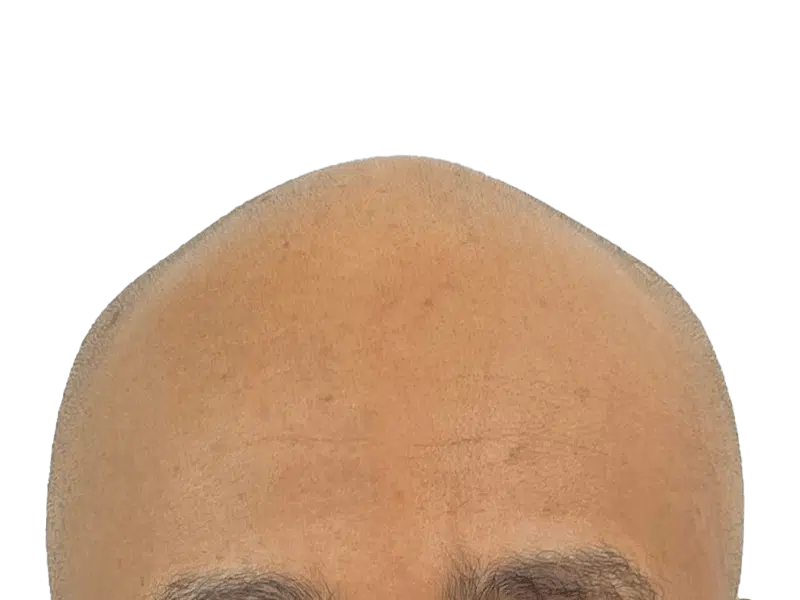 Hair transplant result: Dense, restored hairline on Caucasian man. Before/after potential. Hair restoration success.