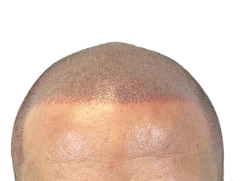Hair transplant result: New hairline with transplanted follicles visible. Redness indicates recent procedure. Hair restoration success.