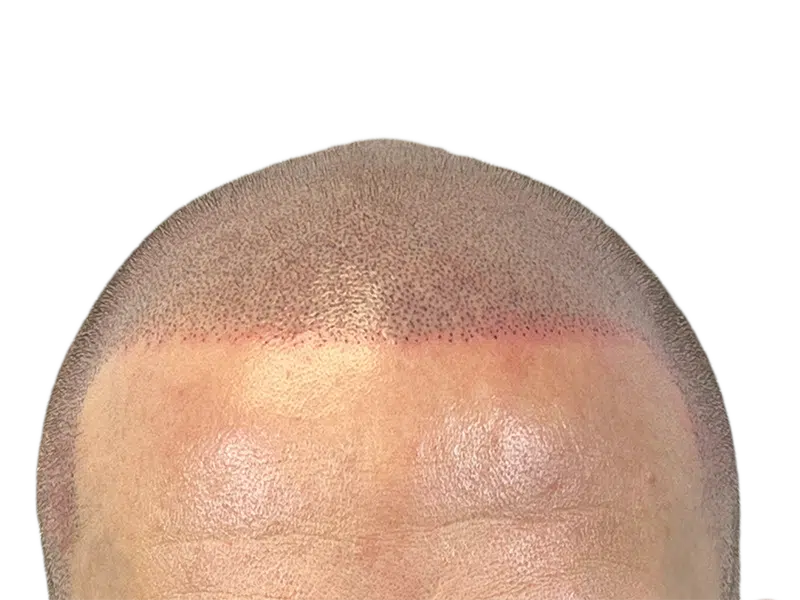 Hair transplant result: New hairline with transplanted follicles visible. Redness indicates recent procedure. Hair restoration success.