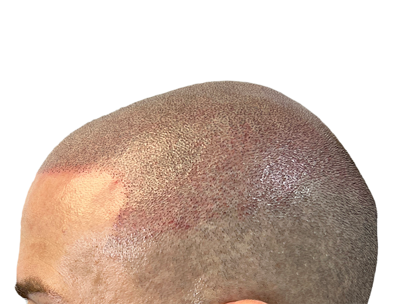 Hair transplant results: Improved density on top & side of head. Hair restoration success.