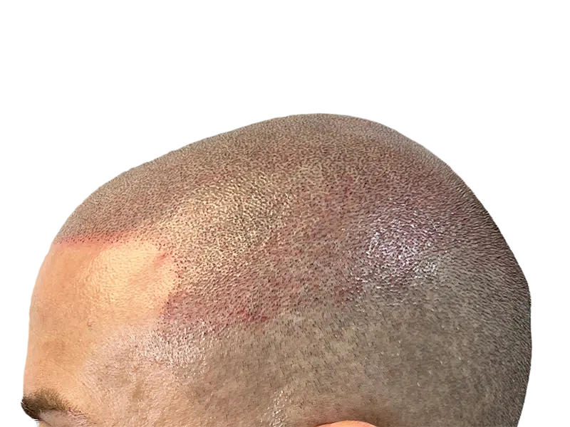 Hair transplant results: Improved density on top & side of head. Hair restoration success.