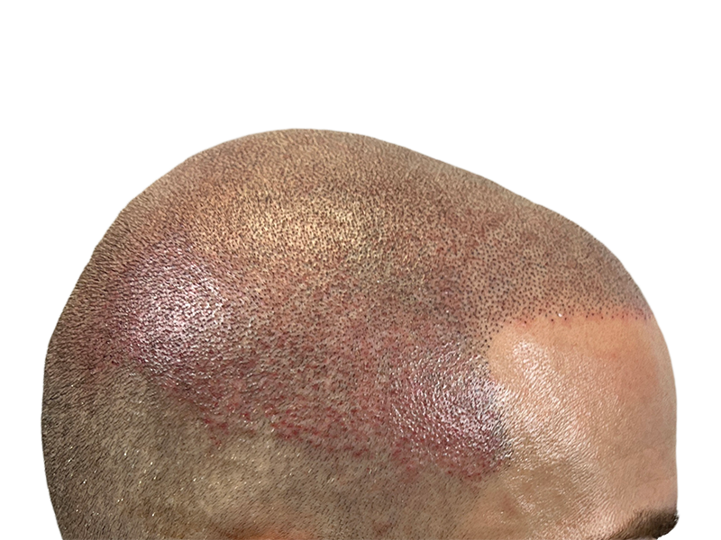 Hair transplant result: Close-up of scalp showing transplanted follicles. Redness is normal. Improved density after hair restoration.