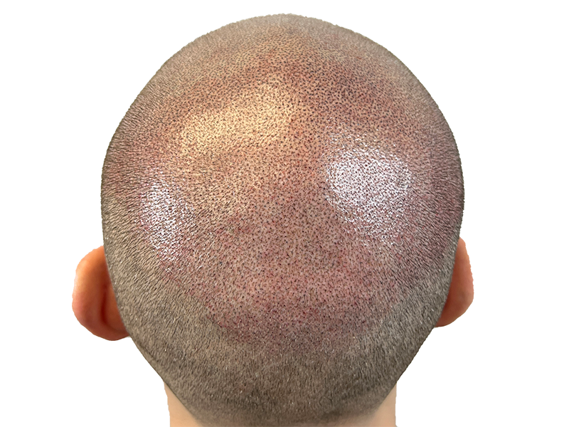 Hair transplant results: Before & after close-up showing restored hair density. Scalp with new hair growth. Hair restoration success.
