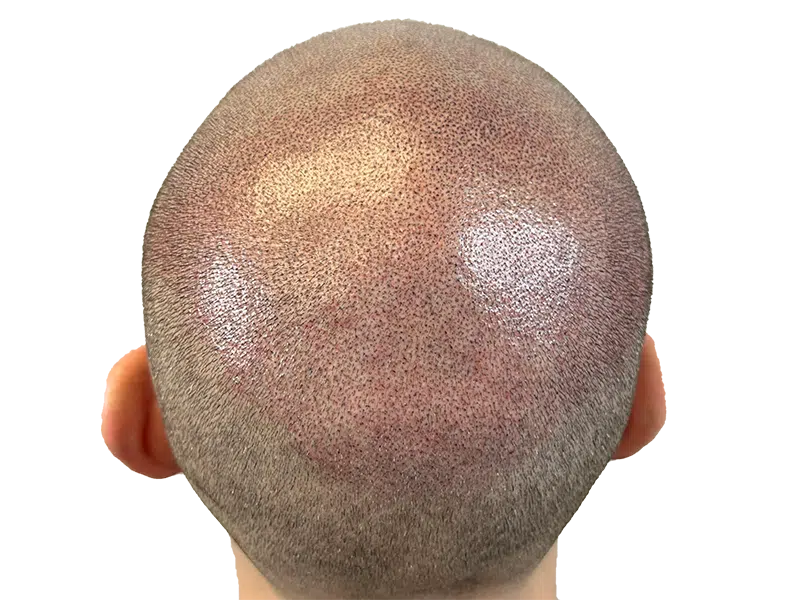 Hair transplant results: Before & after close-up showing restored hair density. Scalp with new hair growth. Hair restoration success.