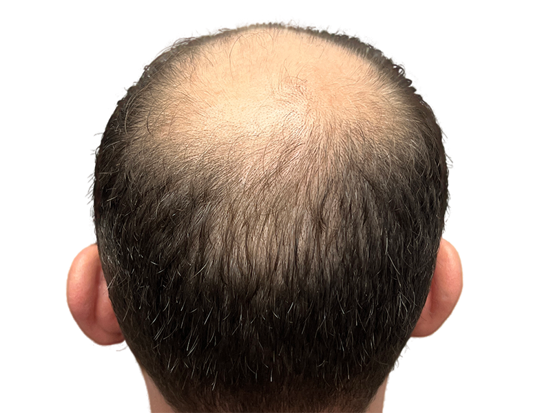 Thinning dark brown hair on a Caucasian man's head. Bald spot visible. Consider hair restoration options for similar hair loss.
