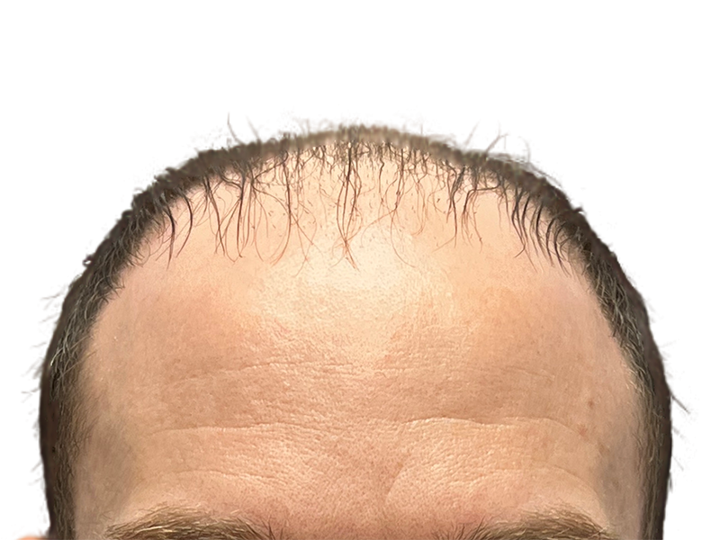 Before hair transplant: Receding hairline with thinning dark hair. Forehead view. Hair restoration candidate.