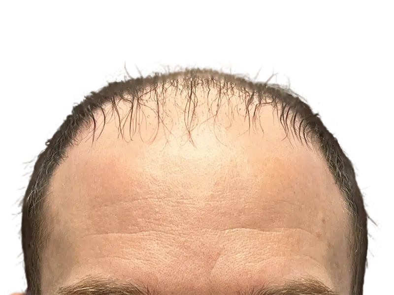 Before hair transplant: Receding hairline with thinning dark hair. Forehead view. Hair restoration candidate.