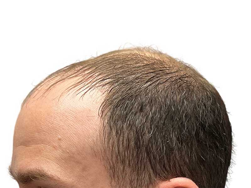 Receding hairline. Before hair transplant. Thinning brown hair shows male pattern baldness. Hair restoration consultation.