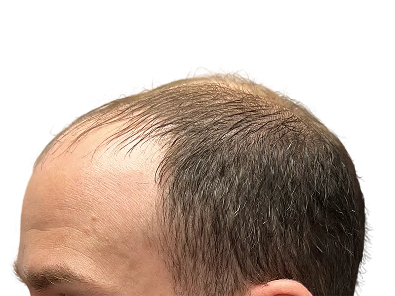 Receding hairline. Before hair transplant. Thinning brown hair shows male pattern baldness. Hair restoration consultation.
