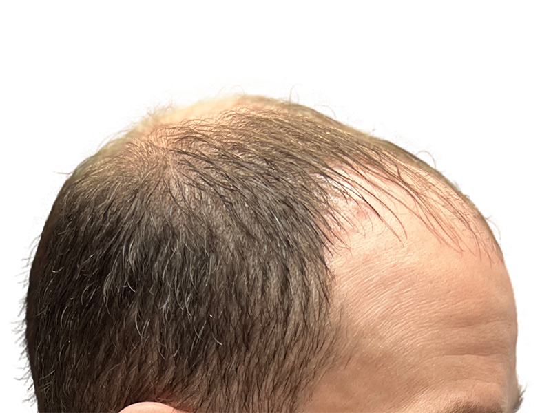 Hair transplant before & after. Receding hairline with sparse hair, improved density after restoration procedure.