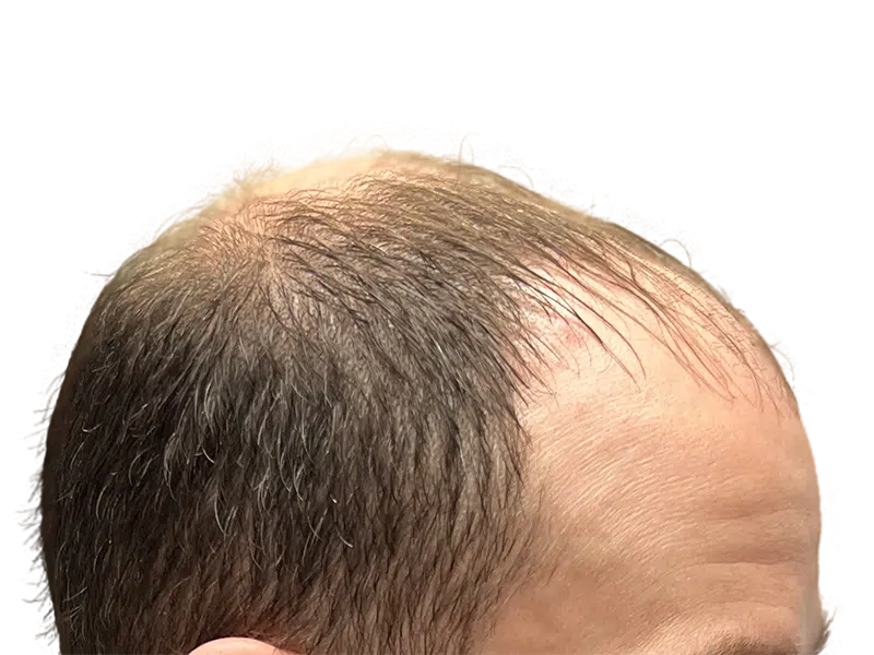Hair transplant before & after. Receding hairline with sparse hair, improved density after restoration procedure.