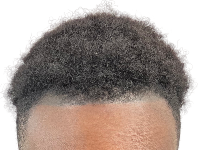 Natural hairline. Hair restoration result? Dark, curly hair. No visible transplant signs. Before/After potential.